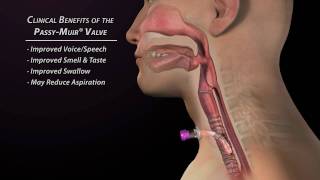 Clinical Benefits of the Passy Muir Valve [upl. by Enyrehtak]