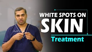 White Spots on Skin Treatment  Remove White Patches  Dr Raj Kirit  Socialpost Health English [upl. by Karmen]