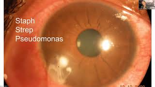 Lecture Corneal Disease and Dystrophy Management [upl. by Dor662]