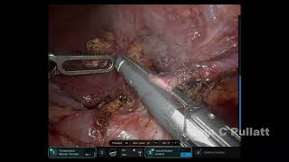 Median Arcuate Ligament Release [upl. by Ddarb]