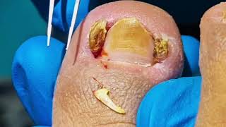 Infected Ingrown Toenail Left Untreated TOO LONG [upl. by Ecnarepmet62]