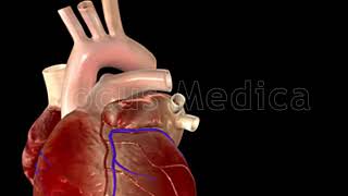 Atrial Fibrillation Triggers  Animated Atlas of Atrial Fibrillation [upl. by Yerxa]