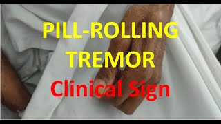 Pill Rolling Resting Tremor  Parkinson Disease [upl. by Enelrae]