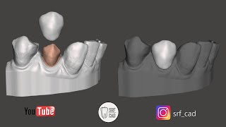 MESHMIXER DENTAL  Tutorial provvisorio in prelimatura con il modello da intraorale TEMPORARY CampB [upl. by Einhoj]