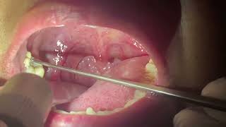 How to remove Tonsil Stones  Immediate Relief after TONSIL STONE Removal [upl. by Ahsiel]