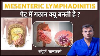 पेट में गठान क्यू बनती है   पेट की सोनोग्राफी में आई हैMesenteric lymphadinitis guthealth [upl. by Bubb800]