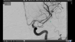 How Endovascular Stroke Treatment Works [upl. by Maude]