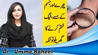 Amazing Way to Remove Skin Tags  Moles  Warts  Dr Umme Raheel [upl. by Tallou575]