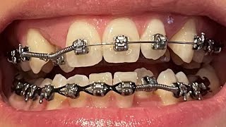 Adult Braces  Time Lapse  26 Month Update [upl. by Nueormahc]