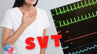 Supraventricular Tachycardia  SVT [upl. by Wilburn]