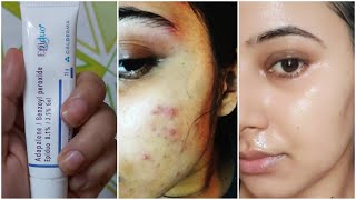 Benzoyl Peroxide to remove Pimples Acne Tiny Bumps Blackheads [upl. by Aleras541]