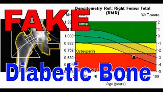 Discovering The Shocking Paradox Of Diabetic Bone Marrow [upl. by Priebe]