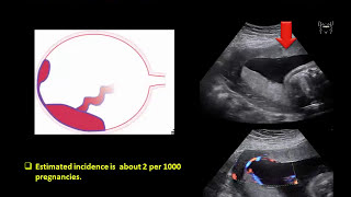 Ultrasound Imaging of the placenta Part 1 Anatomy and Variants [upl. by Netsoj443]