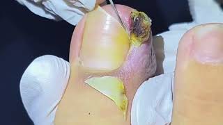 Removing Badly Infected Ingrown Toenails [upl. by Xonk]