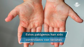 ¿Por qué están comparando a la variante ómicron del coronavirus con el sarampión [upl. by Bertina]