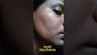 Day30 Using Tretinoin 0025 Cream viralvideo tretinoin skincare shorts youtubeshorts [upl. by Sankaran]