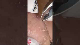 Skincare  Blackheads Removal 192 skincare skincare blackheads blackheads [upl. by Cavanagh]