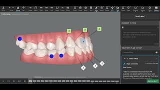 Class III Invisalign [upl. by Ecallaw138]