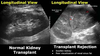 Renal Transplant Doppler Ultrasound Normal Vs Abnormal Images  Transplant Complication  Kidney USG [upl. by Elazaro]