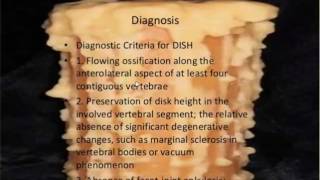 Cervical Stenosis and DISH diffuse idiopathic skeletal hyperstosis [upl. by Hadik]