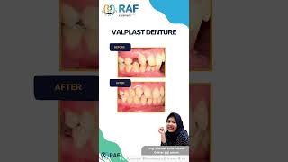 VALPLAST DENTURE dentist doktergigimalang dentalclinic doktergigimalangraya [upl. by Divod92]