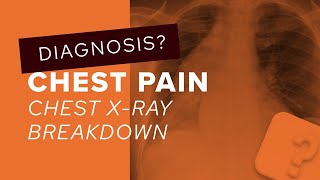 Chest XRay breakdown understanding mediastinal contour [upl. by Neiman]