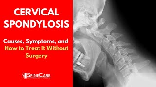 CERVICAL SPONDYLOSIS Causes Symptoms and Treatment NO SURGERY [upl. by Morice885]