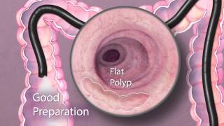 The Importance of Good Bowel Preparation During Colonoscopy [upl. by Acirretal]