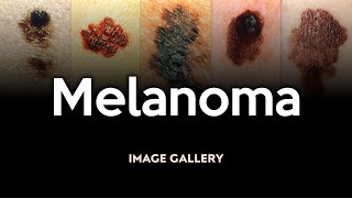 Melanoma Image Gallery [upl. by Marchese333]