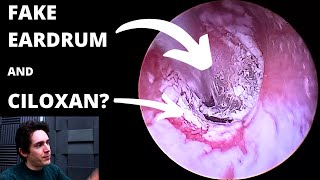 Fake Eardrum And Medication Residue Suction Ciloxan Or Cilodex [upl. by Yssep]