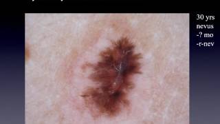 Recurrent nevus or melanoma  Dr Andreas Blum [upl. by Ihtak]