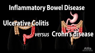 Ulcerative Colitis versus Crohns Disease Animation [upl. by Danila]