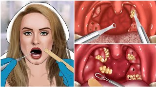 ASMR Remove The Tonsil Stone  Tonsil Stone Removal Animation ASMR Treatment [upl. by Gayelord]