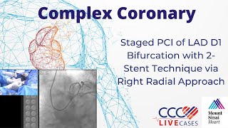 Staged PCI of LAD D1 Bifurcation w 2Stent Technique via Right Radial Approach Dec 15 2015 Webcast [upl. by Earazed]