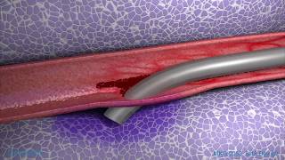 Peripheral IV Infiltration Animation [upl. by Maude]