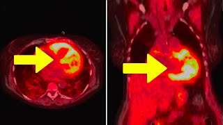 Young Man Takes BrandNew Vitamin K2 Supplement This Happened To His Heart [upl. by Anirtep880]