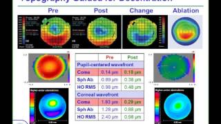 LoVC Course on Therapeutic Corneal Refractive Surgery Part 3 of 6 Decentration [upl. by Allemaj]