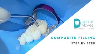 Composite filling  step by step 🦷📚 [upl. by Bartholemy]