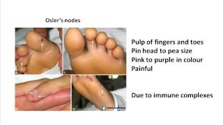 Oslers nodes and Janeway lesions [upl. by Aleit318]