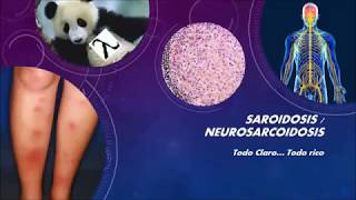 SARCOIDOSIS Y NEUROSARCOIDOSIS Todo claro todo rico [upl. by Dalia]