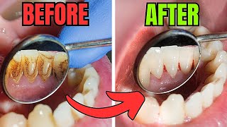 5 Tips to Remove Plaque and Tartar From Teeth [upl. by Yecnahc]