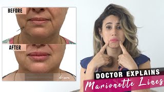 Mouth Wrinkles How to Treat Marionette Lines  Doctor Explains [upl. by Melvina]