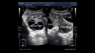 Ultrasound Video showing Two types of Ovarian Cysts and an Ovarian Mass [upl. by Annice]