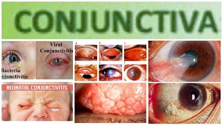 Conjuctiva 3 Major Topic Mucopurulent and Purulent Conjuctivitis [upl. by Ocsicnarf]