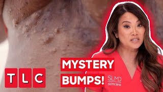 Dr Lee Pops DOZENS Of Mysterious Bumps  Dr Pimple Popper With Every Cystmas Card I Write [upl. by Nate]