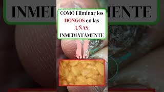 🔥 Cómo Eliminar Hongos en las Uñas Rápidamente en 3 Días 🍋🧄 shortsvideo [upl. by Iztim734]