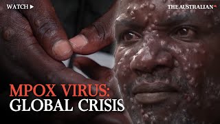 Mpox Outbreak Understanding the global health emergency [upl. by Arej]