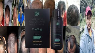 Dermarex Coal Tar Salicylic Acid Scalp Solution  Honest Review [upl. by Ocsicnarf774]