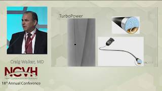 New Tools in Laser Atherectomy Spectranetics Laser [upl. by Peednama]