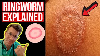 Doctor explains Ringworm aka Tinea including symptoms signs causes and treatment [upl. by Aikahs423]